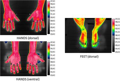 Topical Nifedipine Administration for Secondary Prevention in Frostbitten Patients